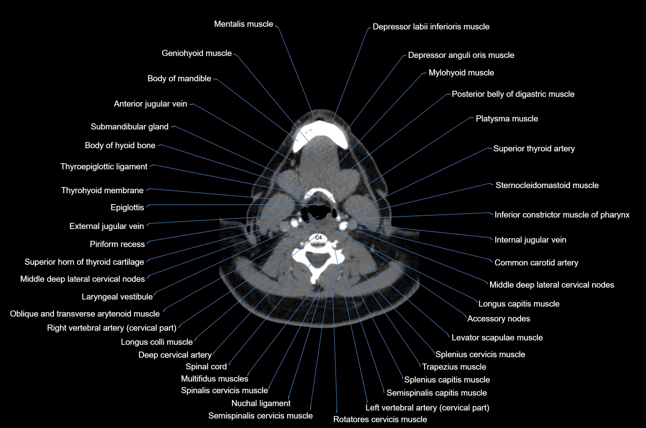 CT Neck axial cross sectional anatomy radiology image-img-00001-00039.webp